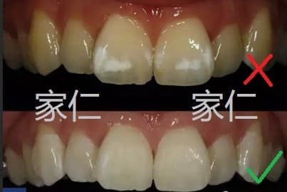 Effective Treatment of White Spots on Teeth: ICON Treatment