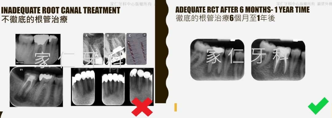 根管治療前後對比圖。左側顯示不徹底的根管治療,導致牙齒持續受損;右側顯示經過6個月至1年後的徹底根管治療,牙齒健康恢復正常。