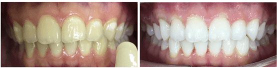 Best Teeth Whitening Effect? HK Cosmetic Dentist tells you How