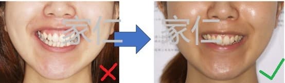 Comparison of Gummy Smile Correction Before and After: The left side shows the gummy smile problem before treatment, and the right side shows the improved results after crown lengthening surgery and orthodontic treatment, enhancing the aesthetics of the smile and oral health.