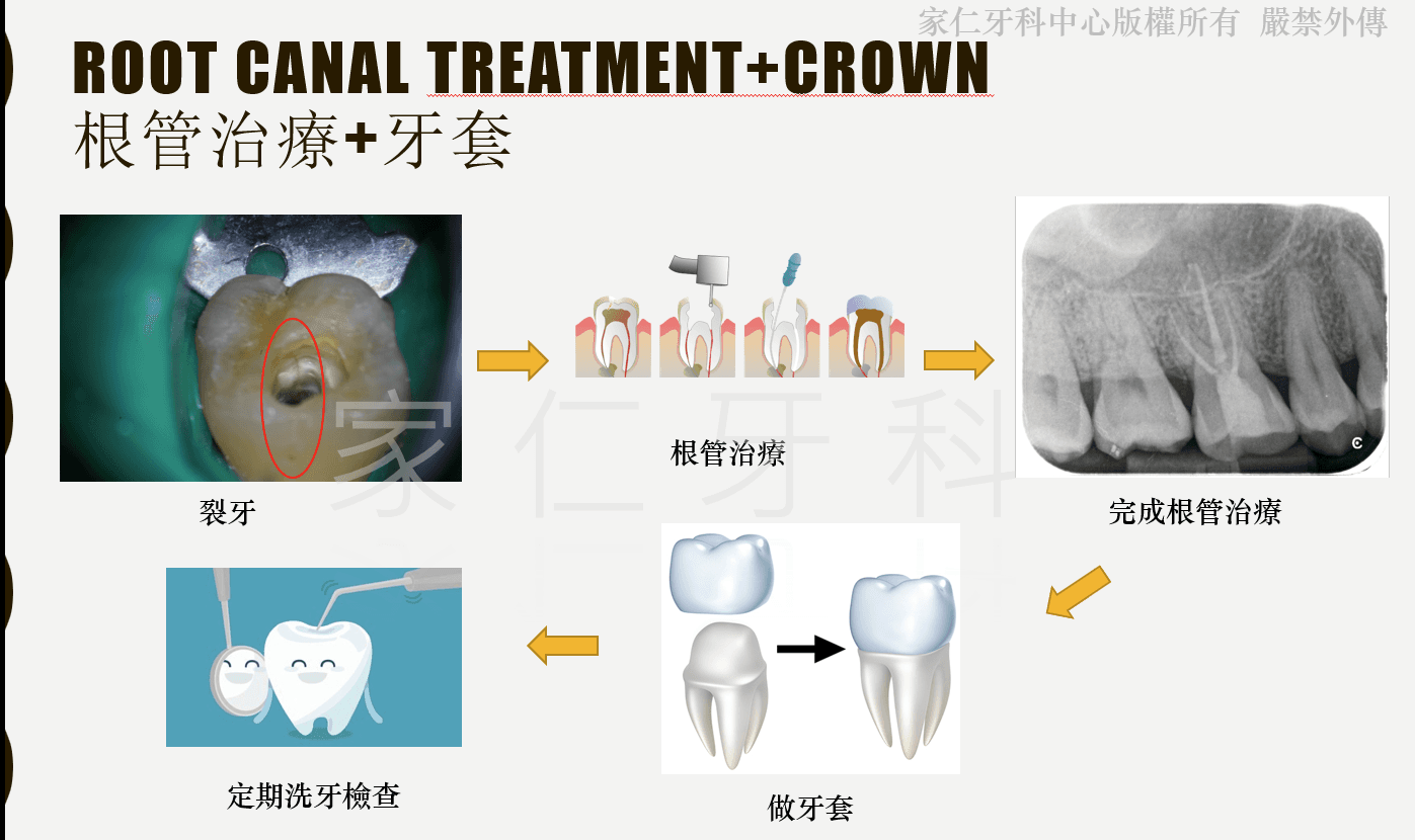 Root Canal Treatment? Checklist to identify failed ones