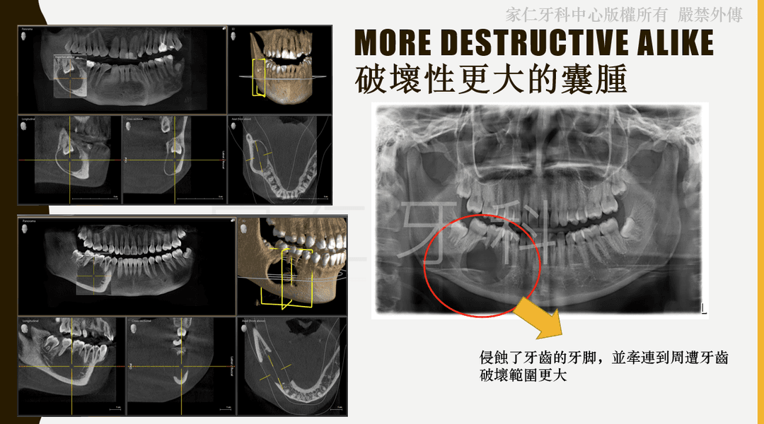顯示牙齒膿腫如果未經治療,會發展成囊腫的影像,包含CT掃描和X光片,顯示破壞性更大的囊腫侵蝕了牙齒的牙腳,並蔓延到周邊牙齒,導致需要進行侵入性手術