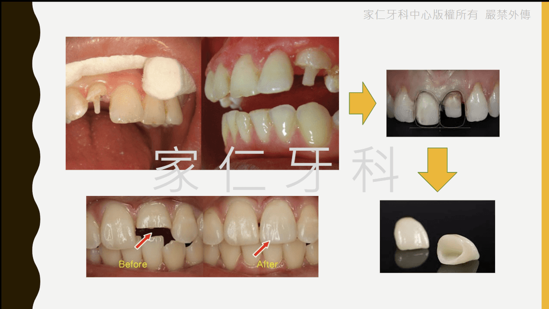 斷裂門牙的根管治療、樁核和牙冠修復,顯示功能和美觀效果的治療前後對比照片