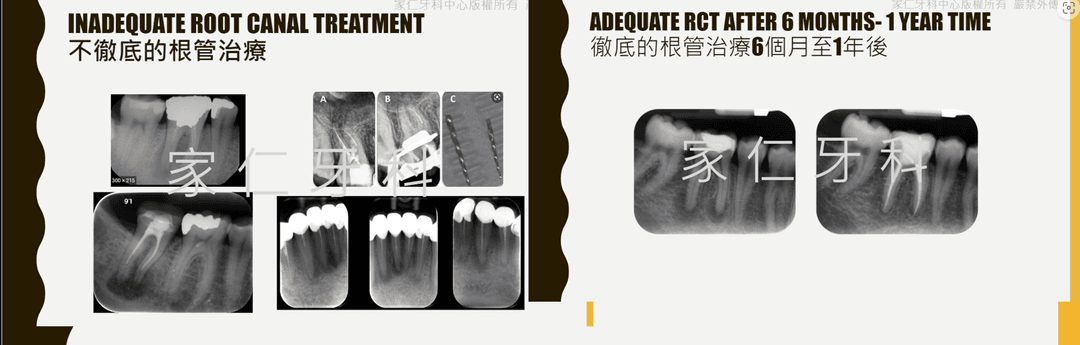 Shows inadequately treated root canal treatment failure with retreatment result photos, demonstrating radiolucency healed with bone growth over time after successful root canal retreatment