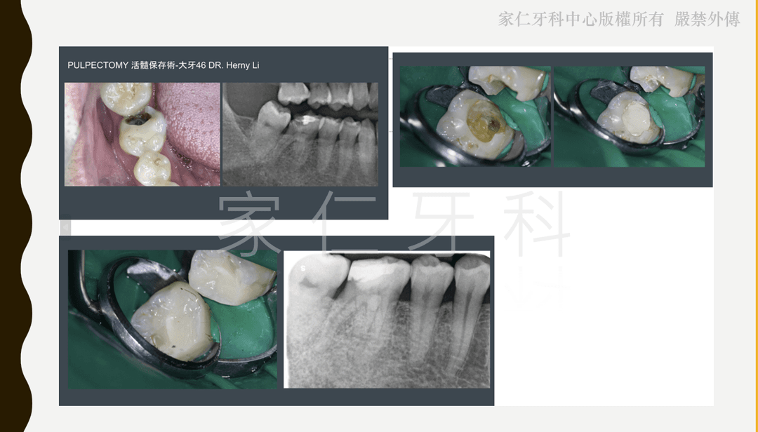 活髓保存術示範,展示使用特殊技術和材料保留健康牙髓部分的技術