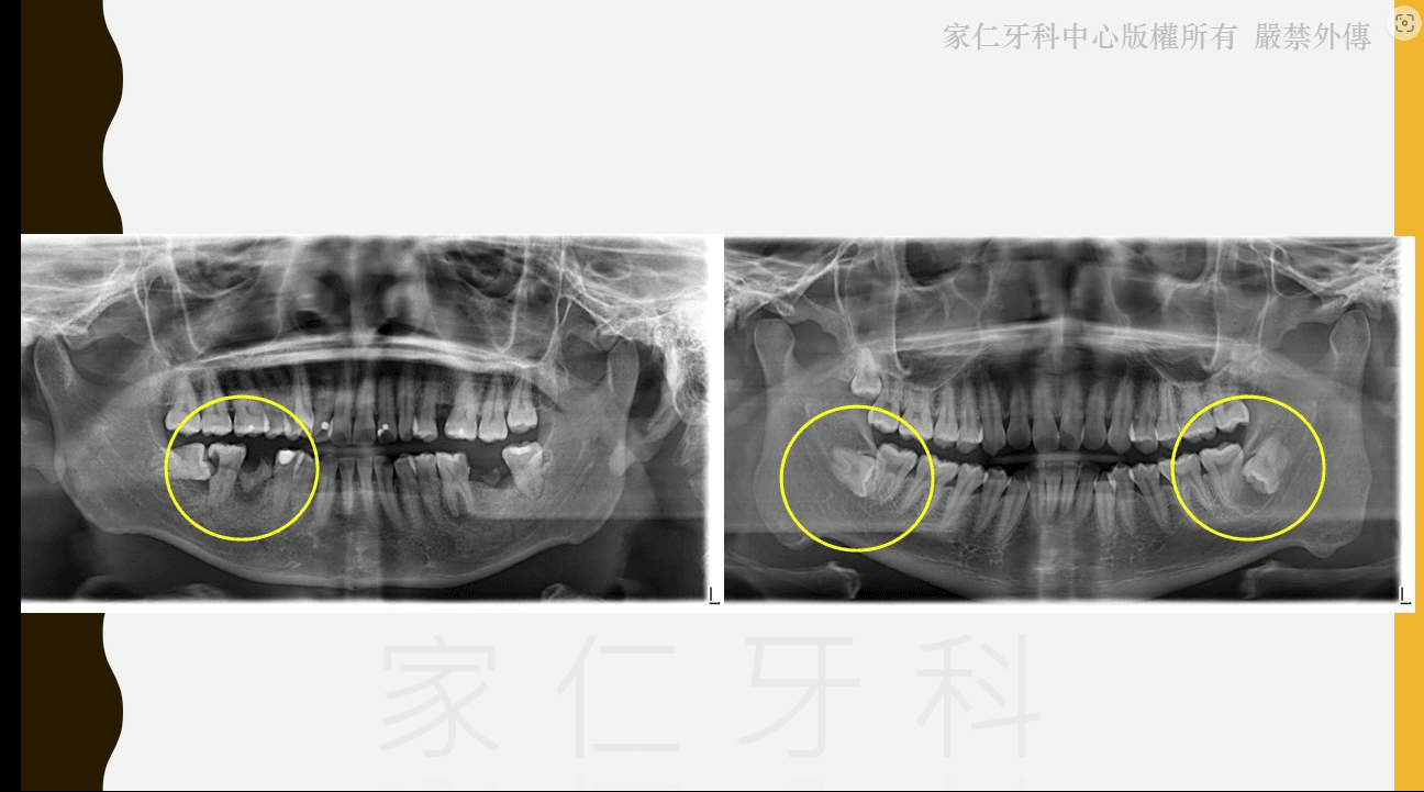 如何有效提高智慧齒拔除手術成功率?【家仁牙科智慧齒牙醫披露】