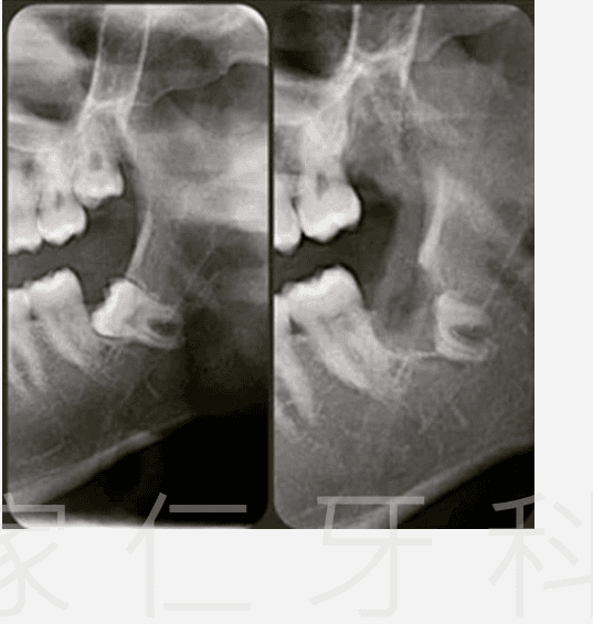 post op pain and swelling wisdom teeth surgery