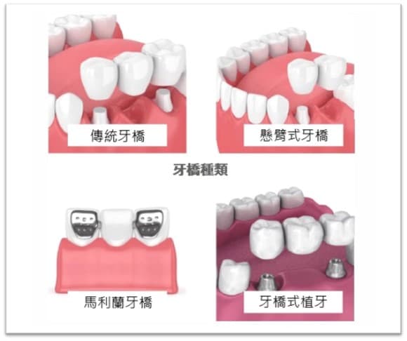 The Role of Crowns and Bridges in Aesthetic Dental Restoration