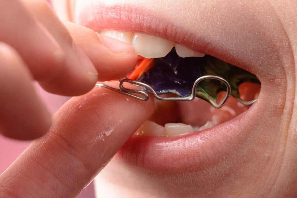 固定器(Retainer):箍牙後必須佩戴的關鍵設備,確保矯正效果持久