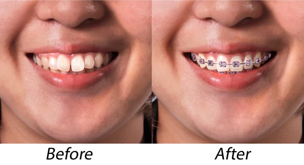 metal brace