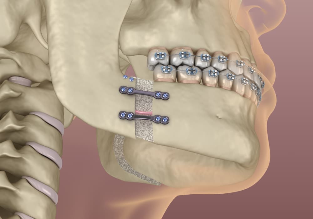 Orthognathic Surgery