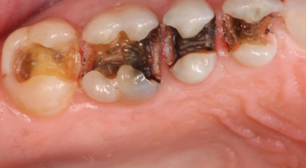 Can You Delay Treating Cavities? Consequences and Worst-Case Scenarios