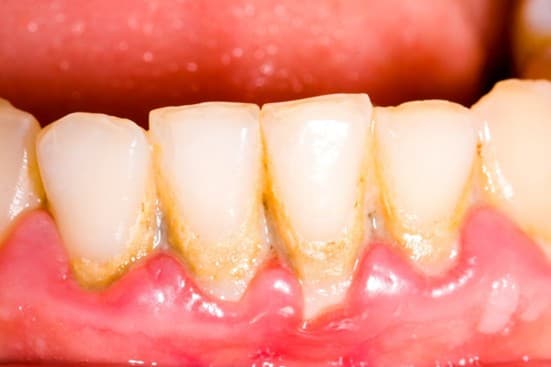 swollen gum dentist