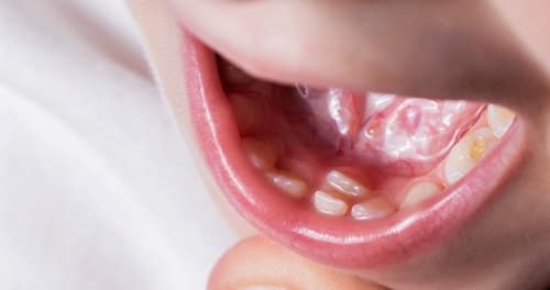【多齒症完全解構】從菊梓喬的「殭屍牙」經歷,看這種牙齒不停生的症狀、成因與正確治療方法