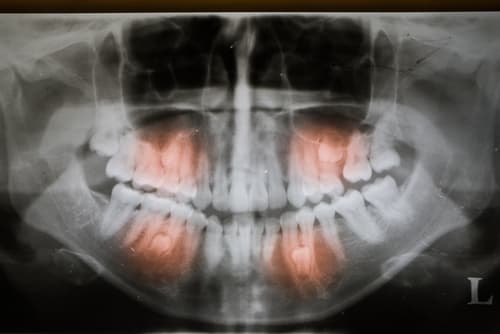 Panoramic dental X-ray image highlighting hyperdontia, with multiple extra teeth (highlighted in red) embedded in the upper and lower jaw.