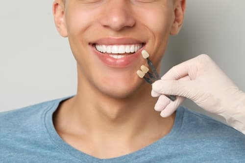 牙醫為男士進行瓷牙貼片色板比對,選擇適合其牙齒與膚色的美白色階。