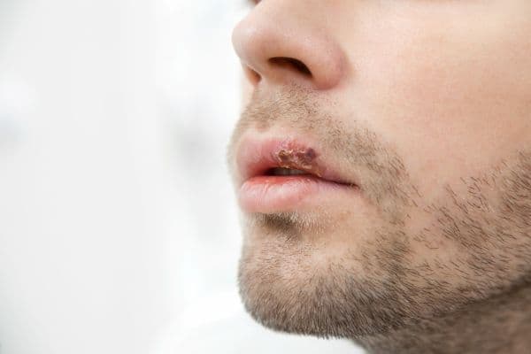 口角炎症原因全面解析:點解嘴角成日裂、紅腫、刺痛?牙醫教你分辨真菌感染、假牙問題與營養缺乏