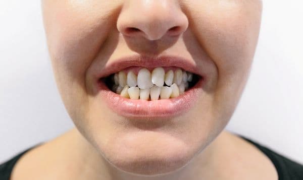dental crowding