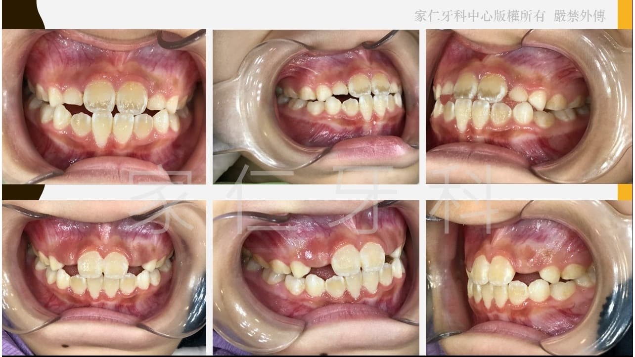 兒童錯咬(倒及)個案口內臨床記錄照片