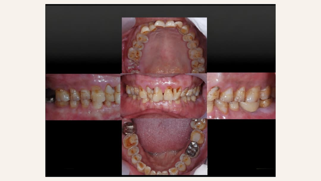 Five-view intraoral pre-treatment record of full mouth tooth wear showing generally shortened teeth and exposed dentine