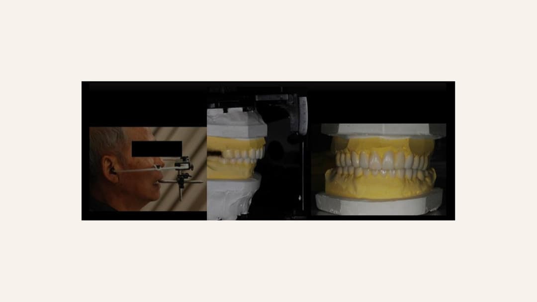 Upper and lower models mounted on a semi-adjustable articulator following facebow transfer, used for occlusal analysis