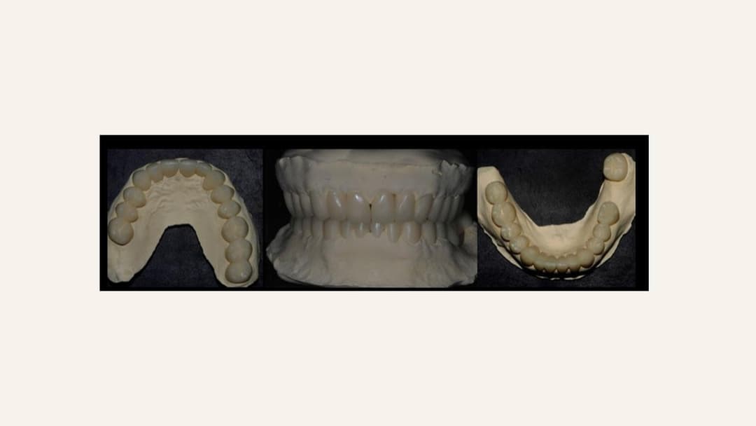 Provisional restorations made for the patient, upper and lower arches with frontal view