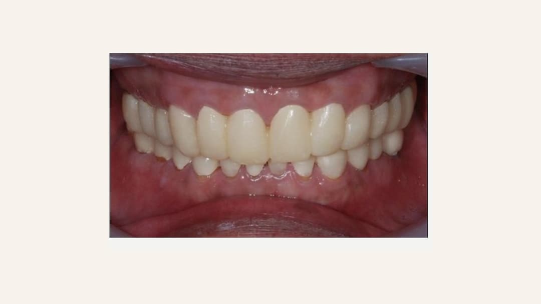 Provisional restorations fitted in the mouth, adapting to the new bite position