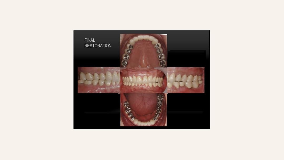 Final full mouth restorations, occlusal views of both arches with frontal and lateral views