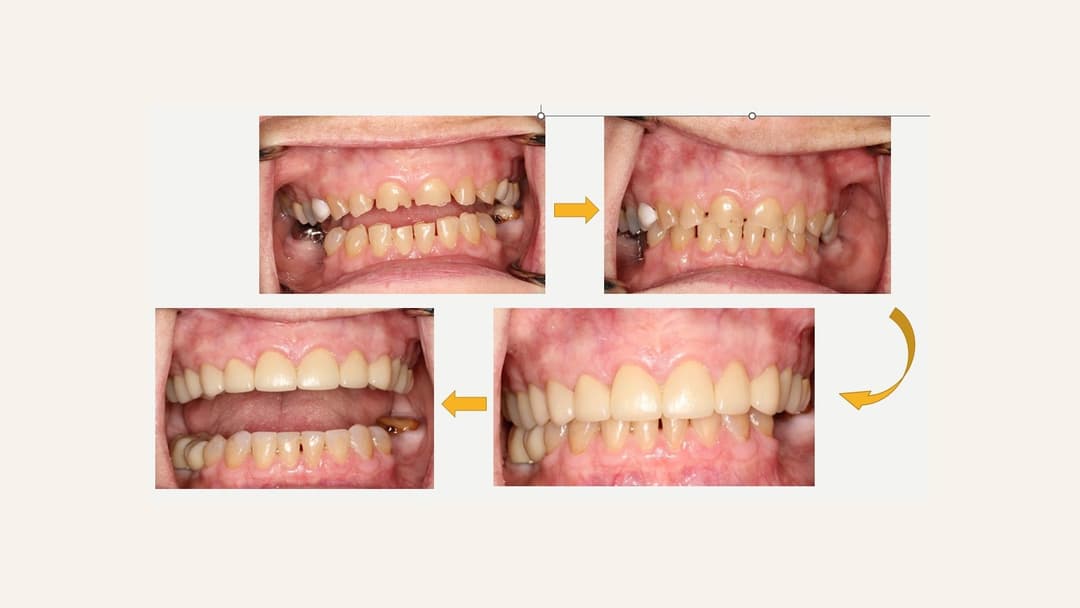 Stage-by-stage progression of full mouth reconstruction for tooth wear