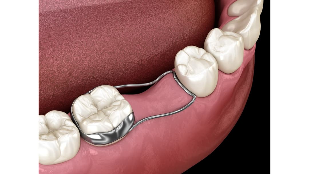 Band-and-loop space maintainer holding the space for the permanent tooth after early loss of a baby tooth