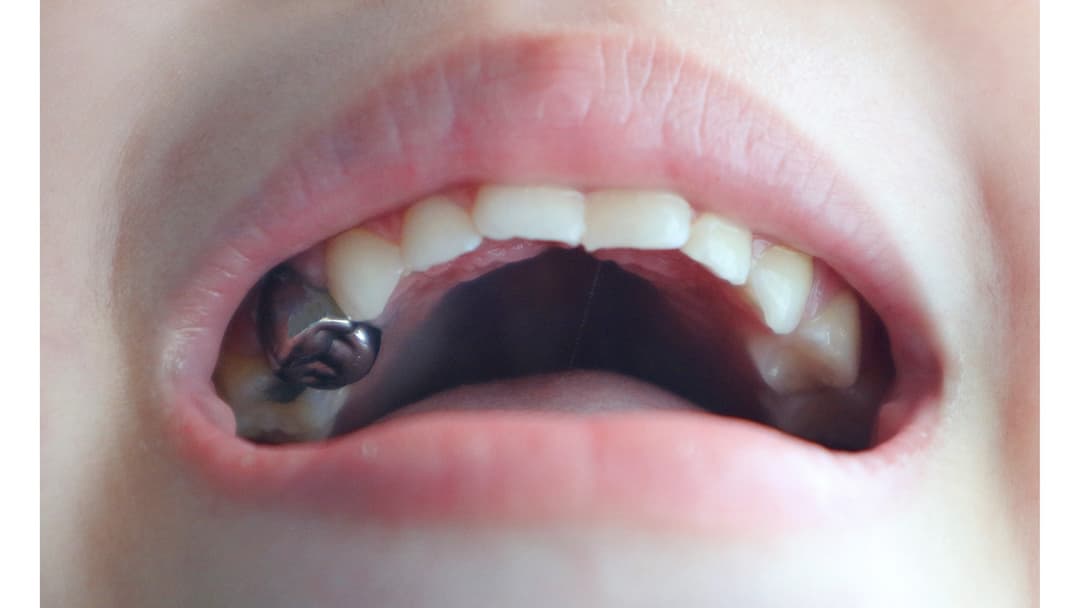 Stainless steel crown (SSC) on a baby molar: full coverage for a heavily decayed tooth