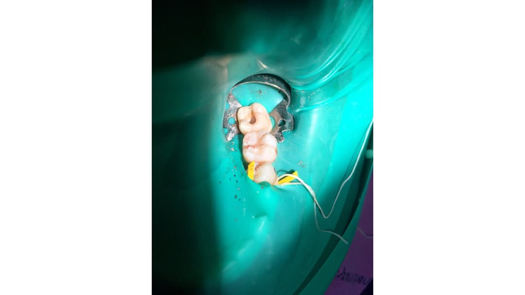 Pulp treatment on a baby tooth carried out under rubber dam isolation