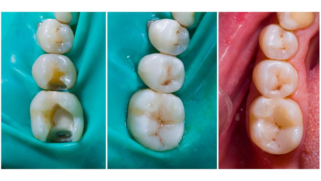 Baby tooth filling before and after: a decayed baby tooth restored with composite resin