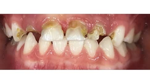 Extensive decay on an upper front baby tooth: before restoration