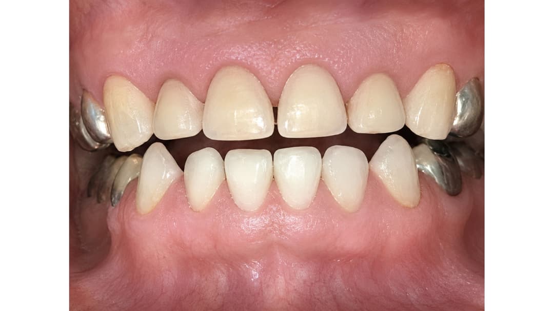 Front baby teeth restored with crowns: appearance after treatment