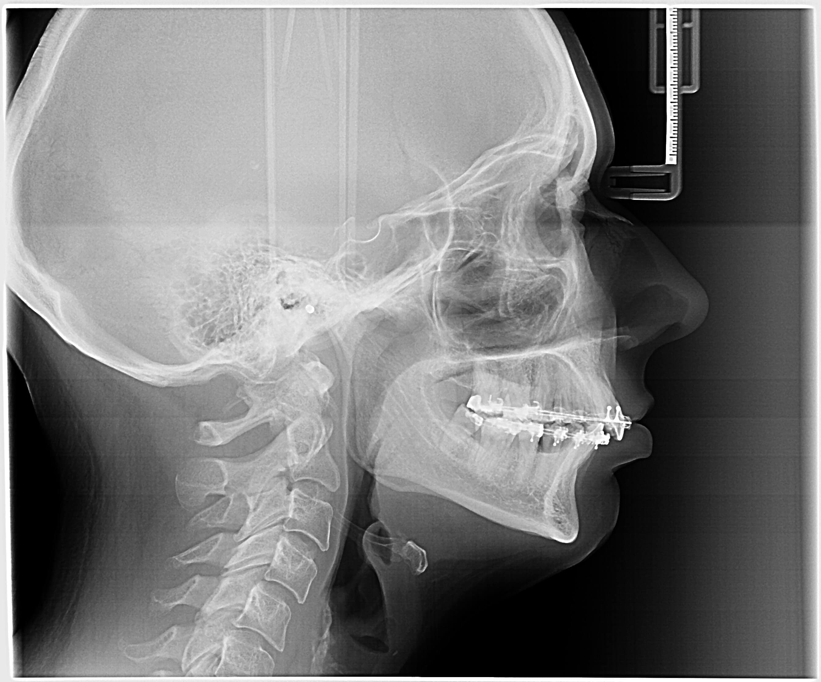 How to handle broken jawbone? (Part 1)