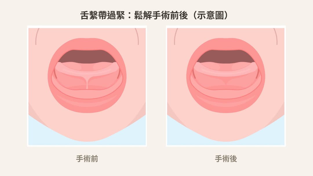 舌繫帶過緊鬆解手術前後示意圖:手術前舌頭活動受限,手術後活動幅度改善