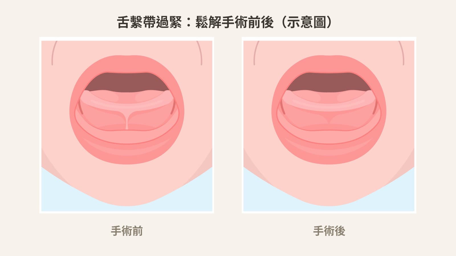 唇繫帶/舌繫帶過短要唔要剪?餵哺、發音、牙縫一次講清