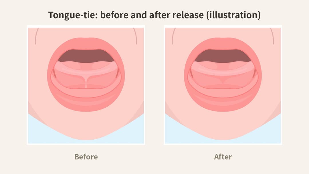 Illustration of tongue-tie before and after frenectomy release, showing improved tongue mobility