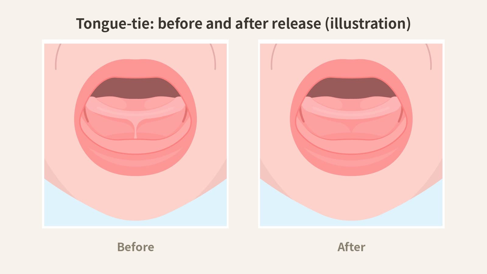 Lip Tie & Tongue Tie: When Does a Frenectomy Actually Help?