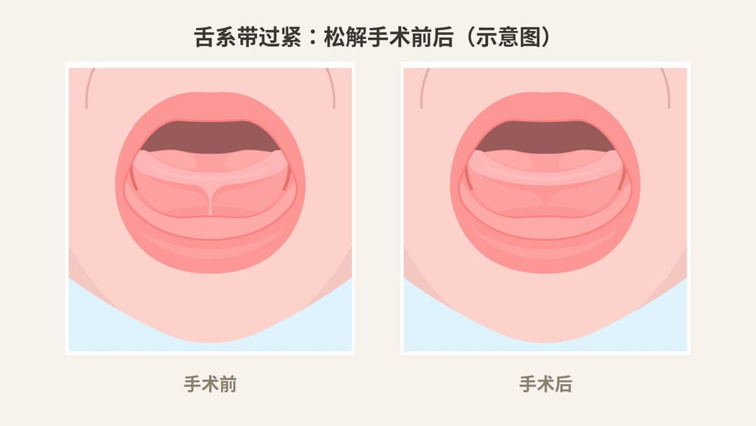 舌系带过紧松解手术前后示意图:手术前舌头活动受限,手术后活动幅度改善